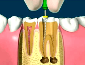 Endodoncia