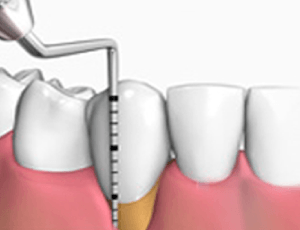 Periodoncia